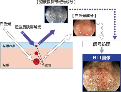 BLI（Blue LASER Imaging）