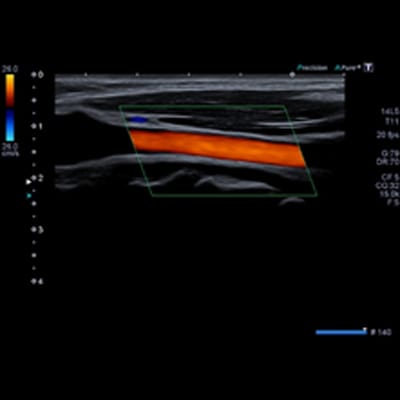頸動脈エコー検査